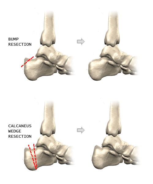 하글런드 변형, 하글런드 증후군 재활운동 Haglund's Deformity Disease, Pump Bump