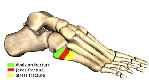 5th metatarsal fracture jones