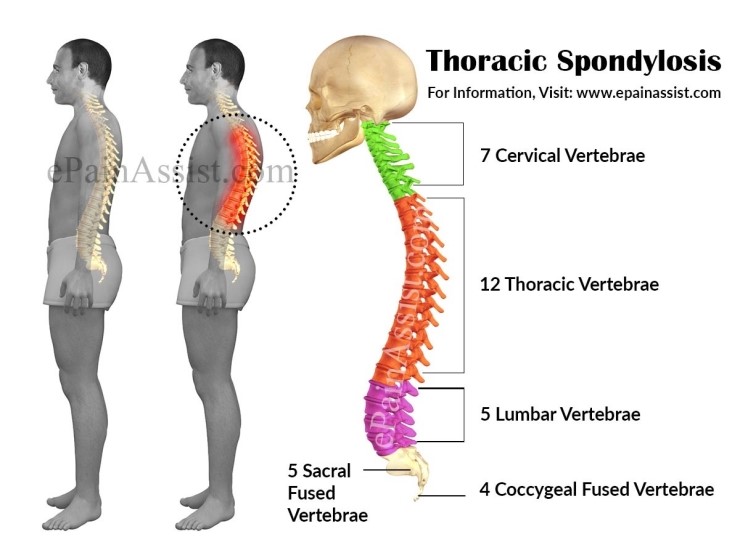 흉추/요추 척추증(Thoracic/Lumbar spondylosis) 40세 이상의 중년에서 오래된 등, 허리 통증이 있어요