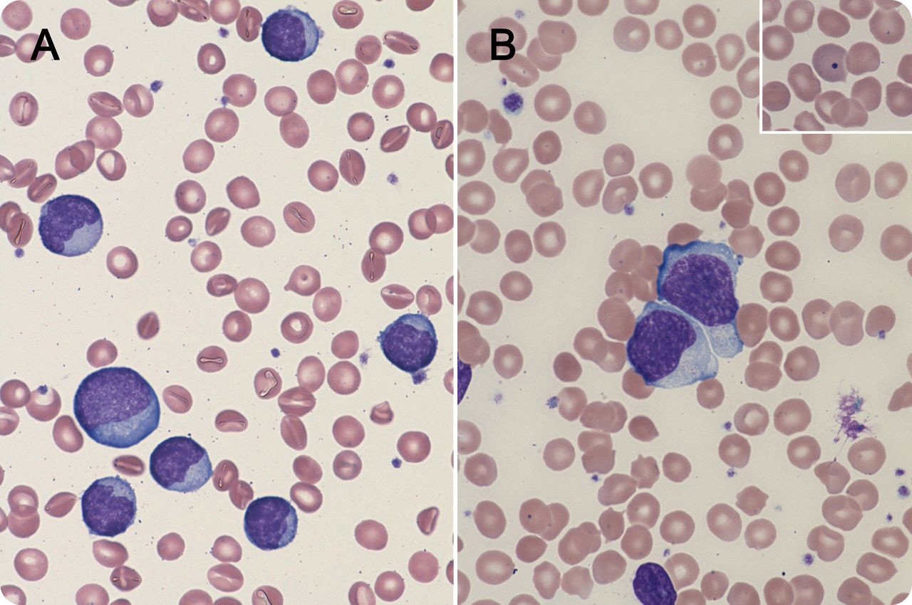 ebv-heterophile-antibody