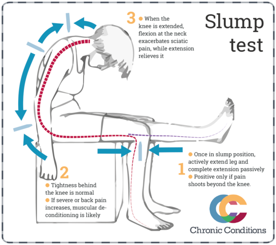 slump test for sciatica