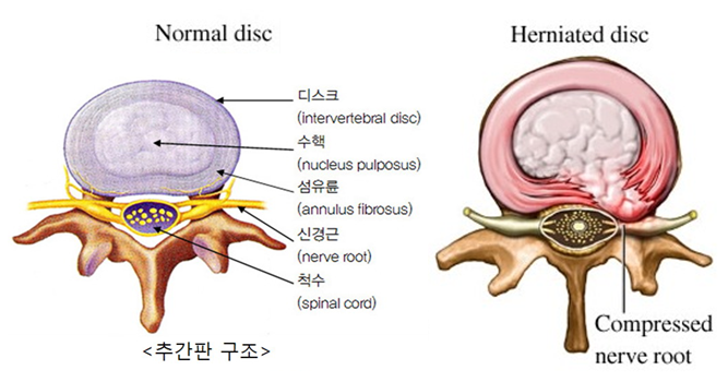 Herniated Disc NYC-Sciatica NYC-Back Pain Treatment