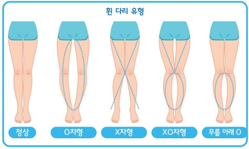 [수원 다나요가] 고관절 내회전(골반전방경사)으로 인한 O, X다리유형, 고관절 외회전(골반후방경사)으로 인한 O, X다리유형