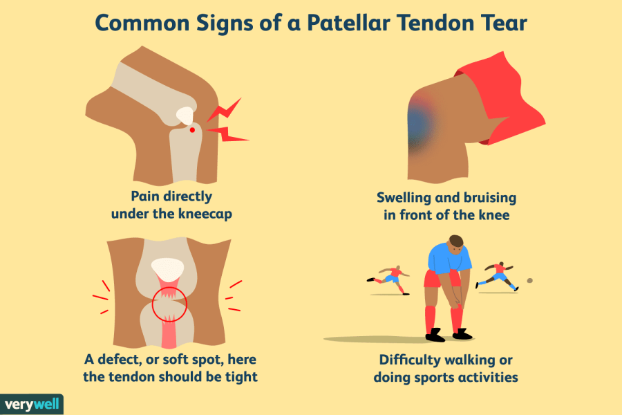 treatment-of-a-patellar-tendon-tear-25495911-5c77359a46e0fb0001d83ca7.png