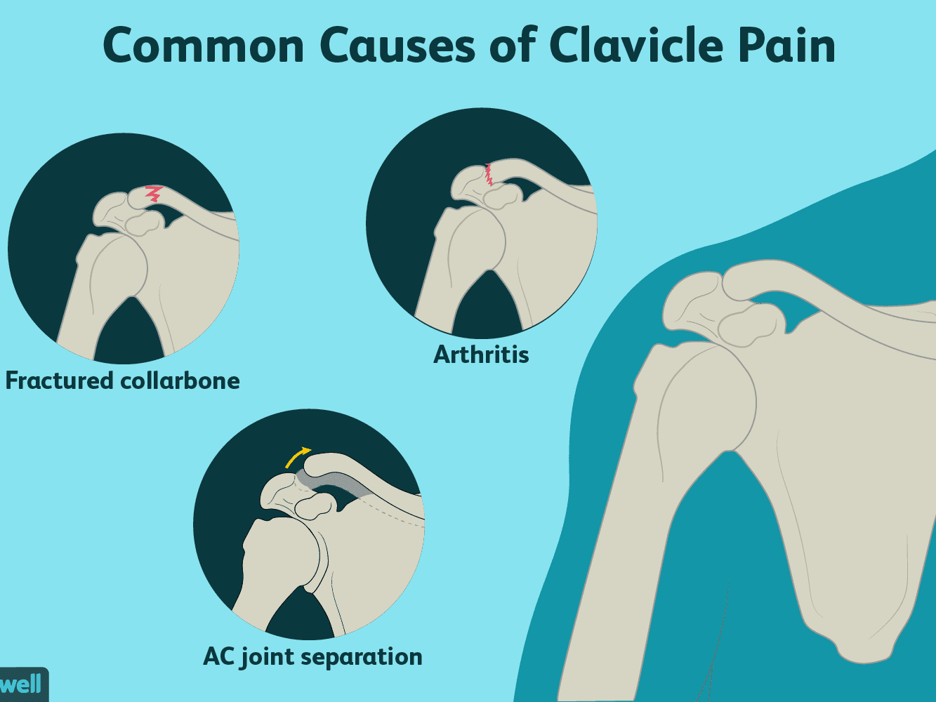 claviclepainfinal-01-5c6331df46e0fb0001f255a5.png