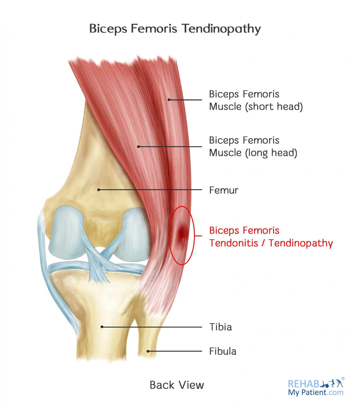 Biceps_Femoris_Tendinopathy.jpeg