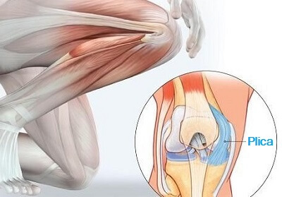 plica-syndrome.jpg