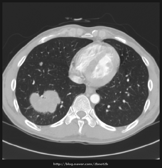 폐암4기뇌전이(Lung cancer,satge IV. Brain metastasis) 네이버 블로그