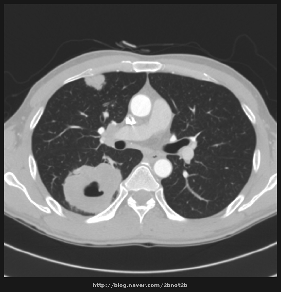 폐암4기뇌전이(Lung cancer,satge IV. Brain metastasis) 네이버 블로그