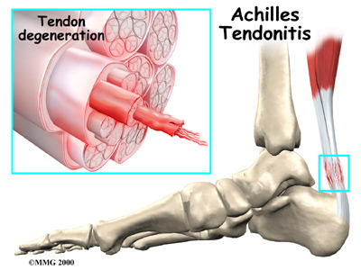 아킬레스 건염 및 아킬레스건 파열(Achilles Tendonitis/Rupture) : 네이버 블로그