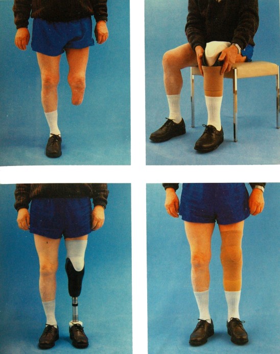 Knee prosthesis