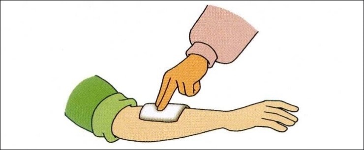 응급처치방법 - 압박지혈 : 네이버 블로그