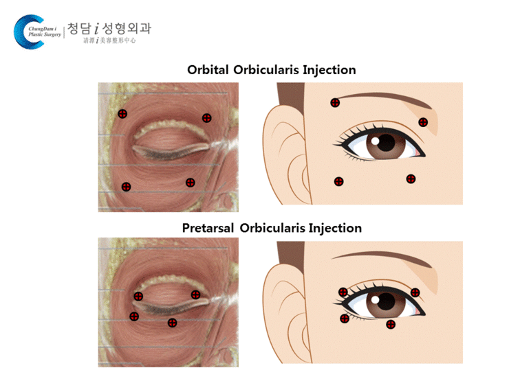  benign essential blepharospasm beb 