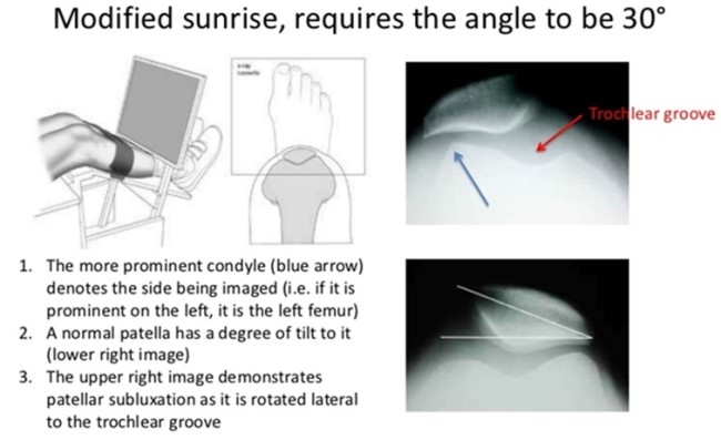 Knee X-ray의 Anatomy와 Positioning : 네이버 블로그
