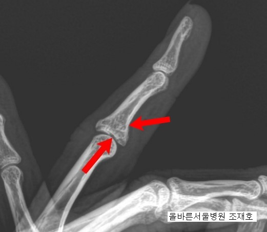 손가락의 중위지골 수장판 견열 골절에서의 나사 고정술(ORIF with miniscrew at volar plate ...
